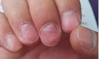 治疗灰指甲要多少钱 灰指甲治疗需多少钱